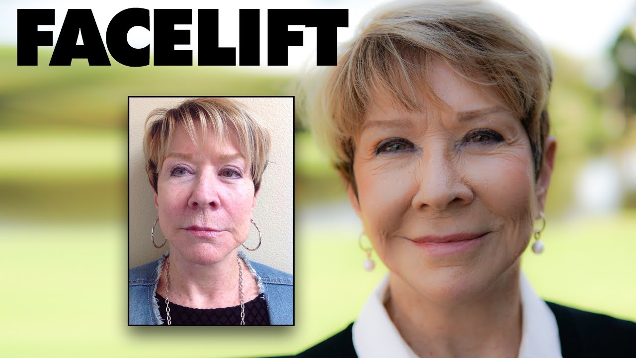 Facelift - 5 YEAR Post Op - Real Patient Story