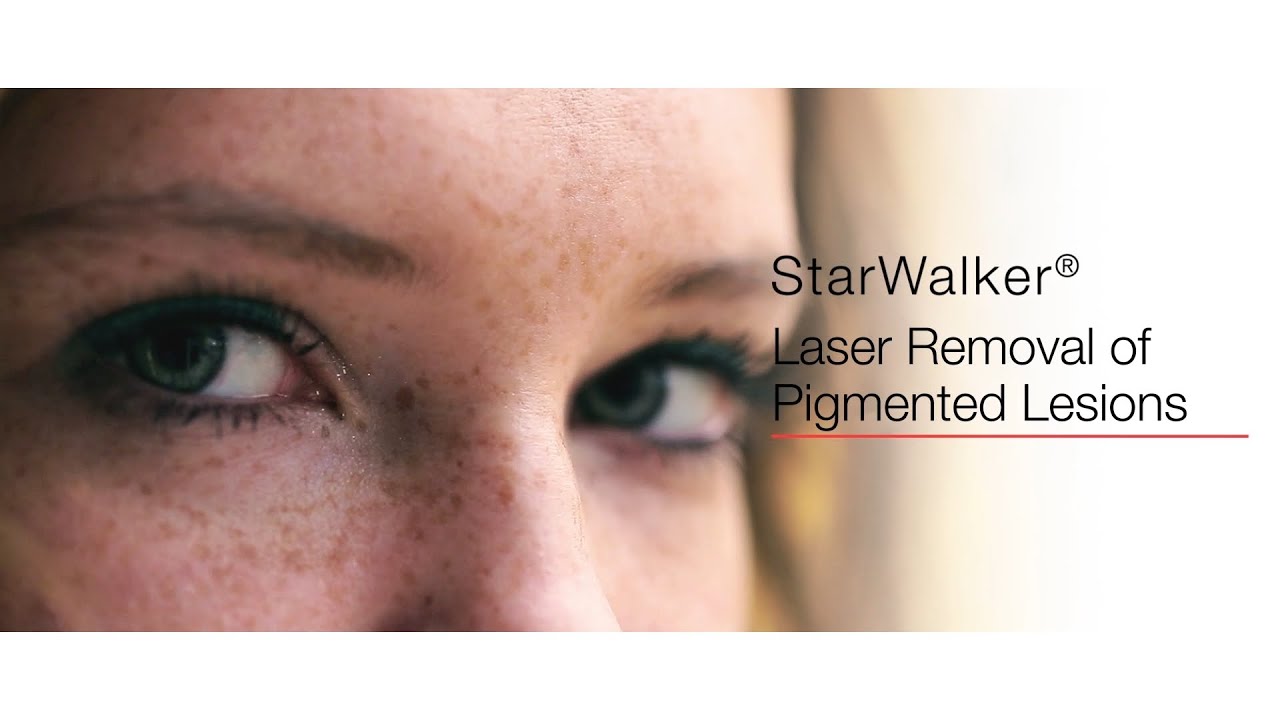 Laser Removal of Pigmented Lesions