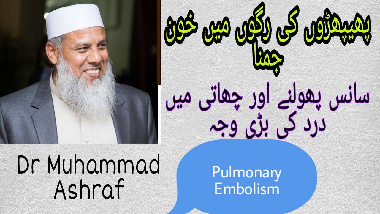 Pulmonary embolism | Risk factors,Symptoms and treatment  in urdu | Dr Muhammad Ashraf