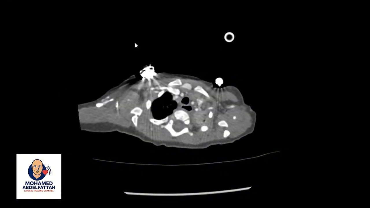 Butterfly pulmonary arteries