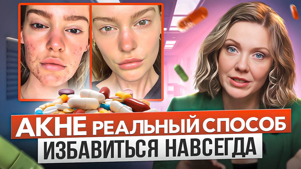Эффективные средства для лечения Акне. Угревая болезнь - симптомы, причины, лечение акне.