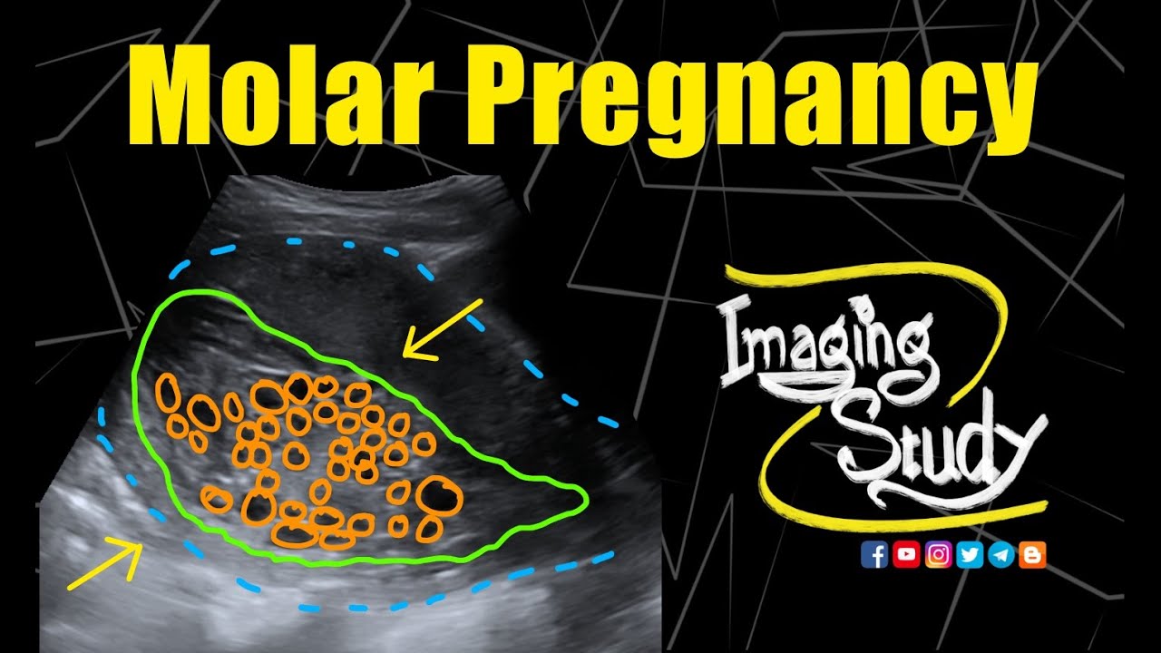 Molar Pregnancy || Hydatidiform Mole || Ultrasound || Case 281