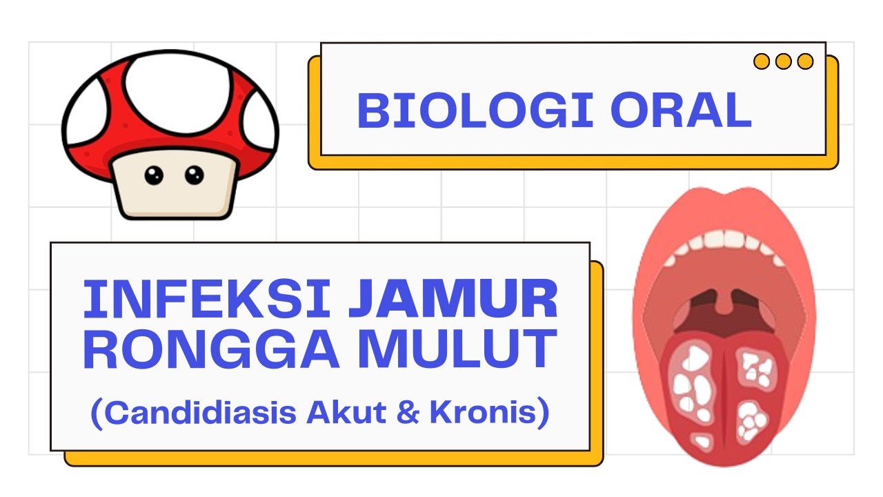 Ringkasan Oral Candidiasis (Pseudomembran, Eritematous, Hiperplastik, dsb...) | Penyakit Mulut 101