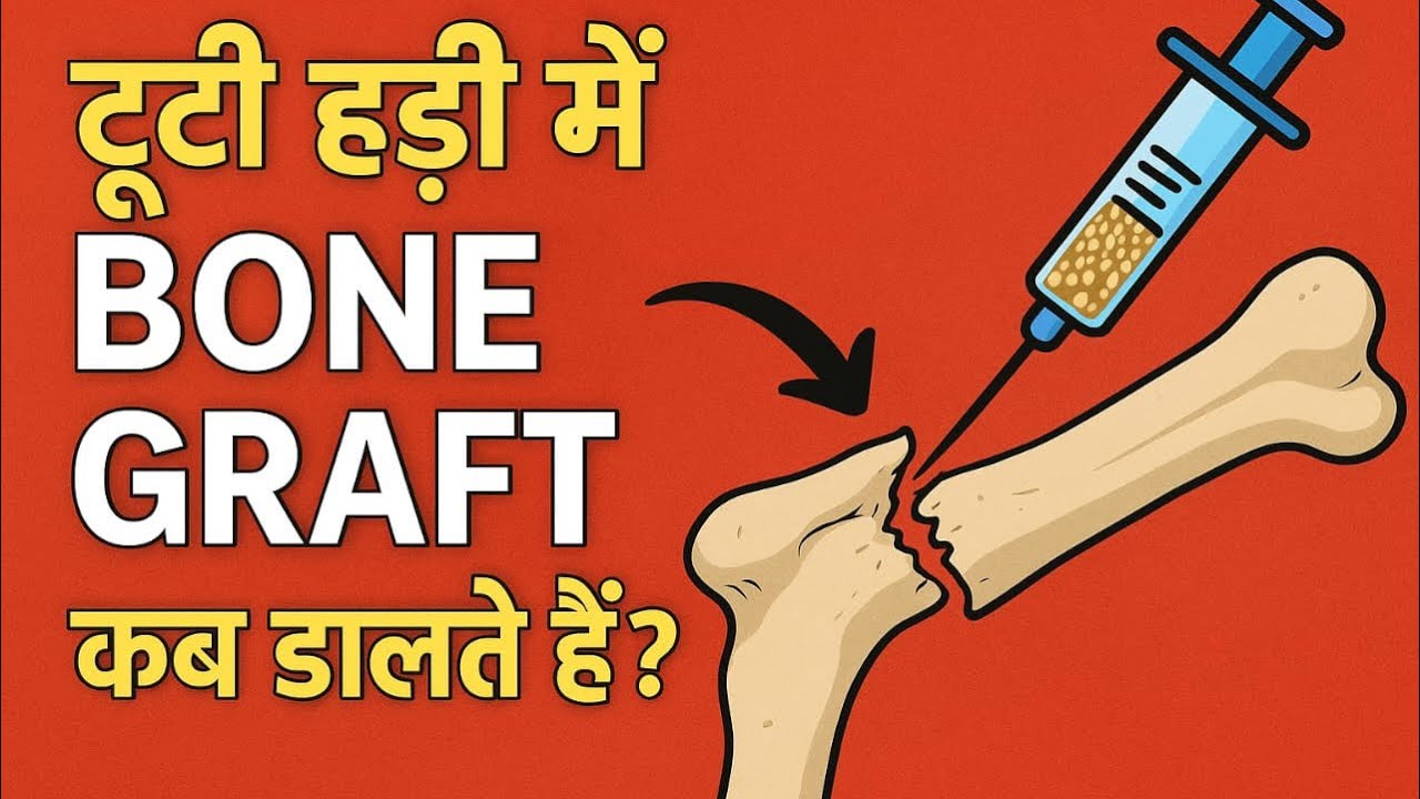 फ्रैक्चर में बोन ग्राफ्ट कब ज़रूरी होता है
