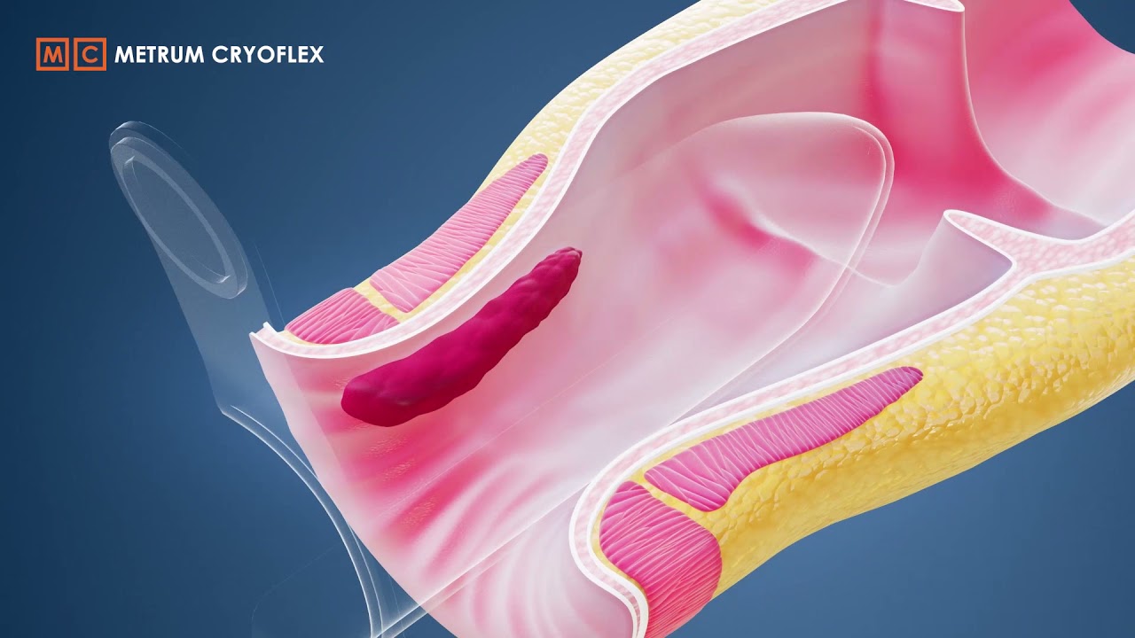 M.I.L.H. procedure - Minimally Invasive Laser Hemorrhoidoplasty. METRUM CRYOFLEX