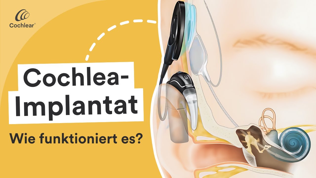Wie funktioniert ein Cochlea-Implantat?