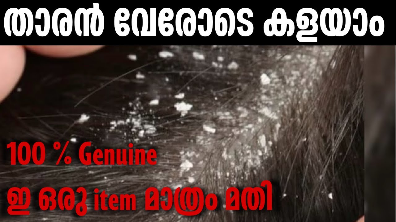 താരൻ പൂർണ്ണമായി മാറുന്ന രഹസ്യം. ഇ ഒരൊറ്റ item മാത്രം മതി ഇനി താരൻ വരില്ല… 100% Geniune 