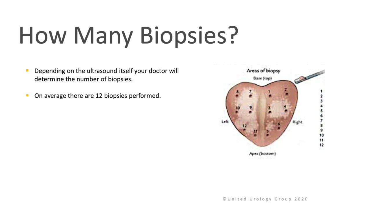 TRUS Prostate Biopsy
