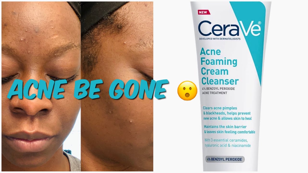 NEW CERAVE ACNE FOAMING CREAM CLEANSER REVIEW | ACNE CLEARED AFTER 1 WEEK! | SOSO MODELS