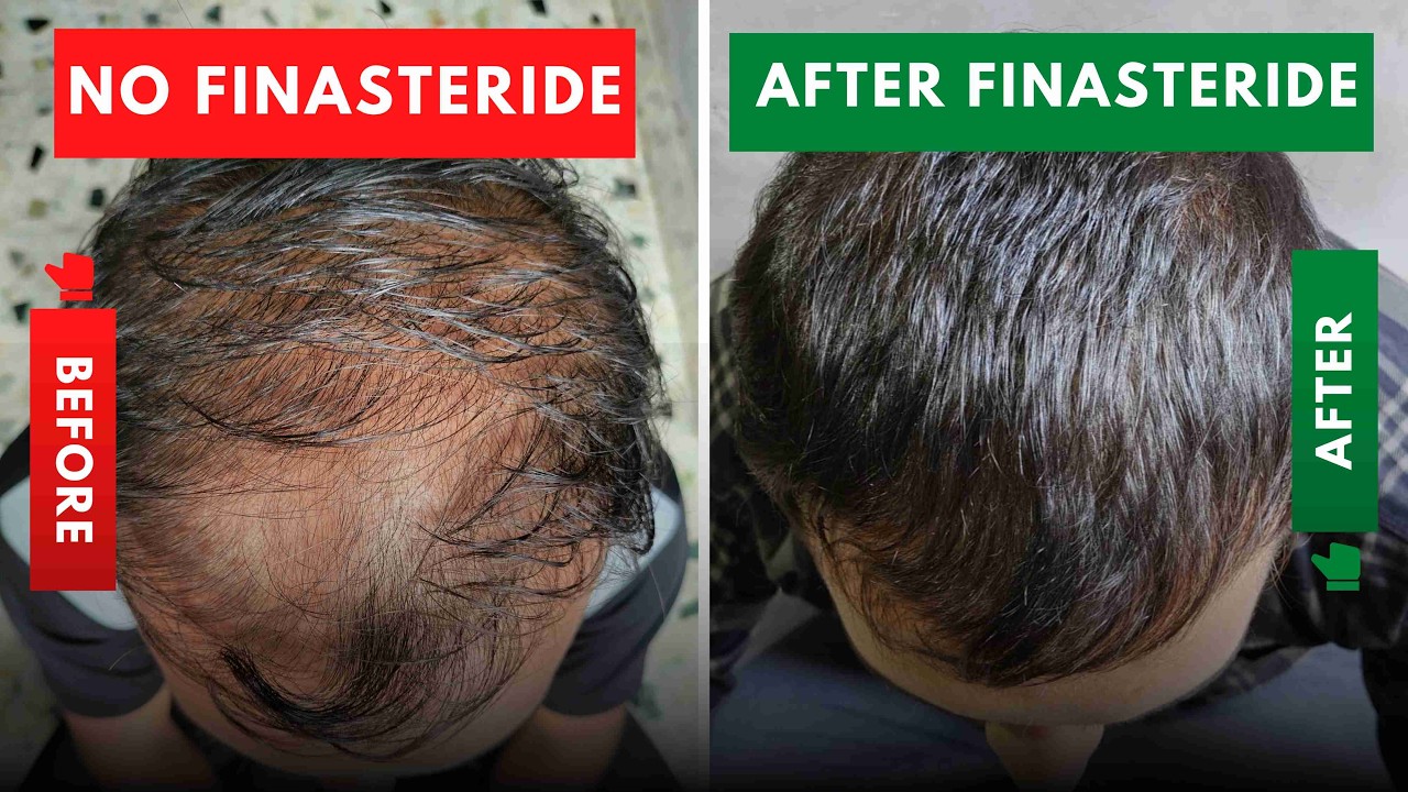 Is finasteride safe in hair loss treatment for men? | Results of Finasteride and Minoxidil | India