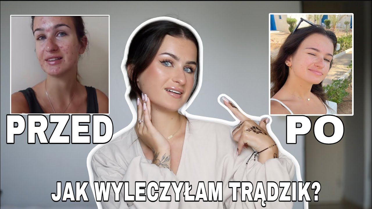 MÓJ TRĄDZIK NIE WRACA - DOWIEDZ SIĘ DLACZEGO!