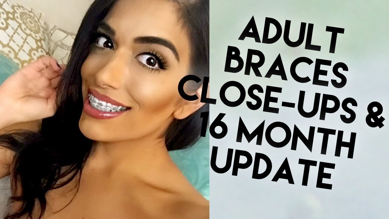 Adult Braces Journey: Metal Braces Close-Ups and 16 Month Progress | JillianVita Lore