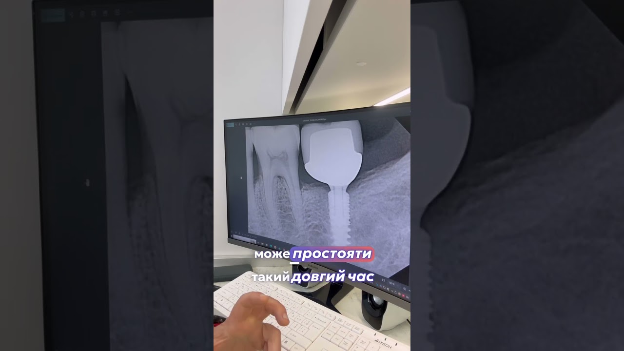 Зубний імплантат через 10 років!Принципи успішної зубної імплантації в olanko.com.ua