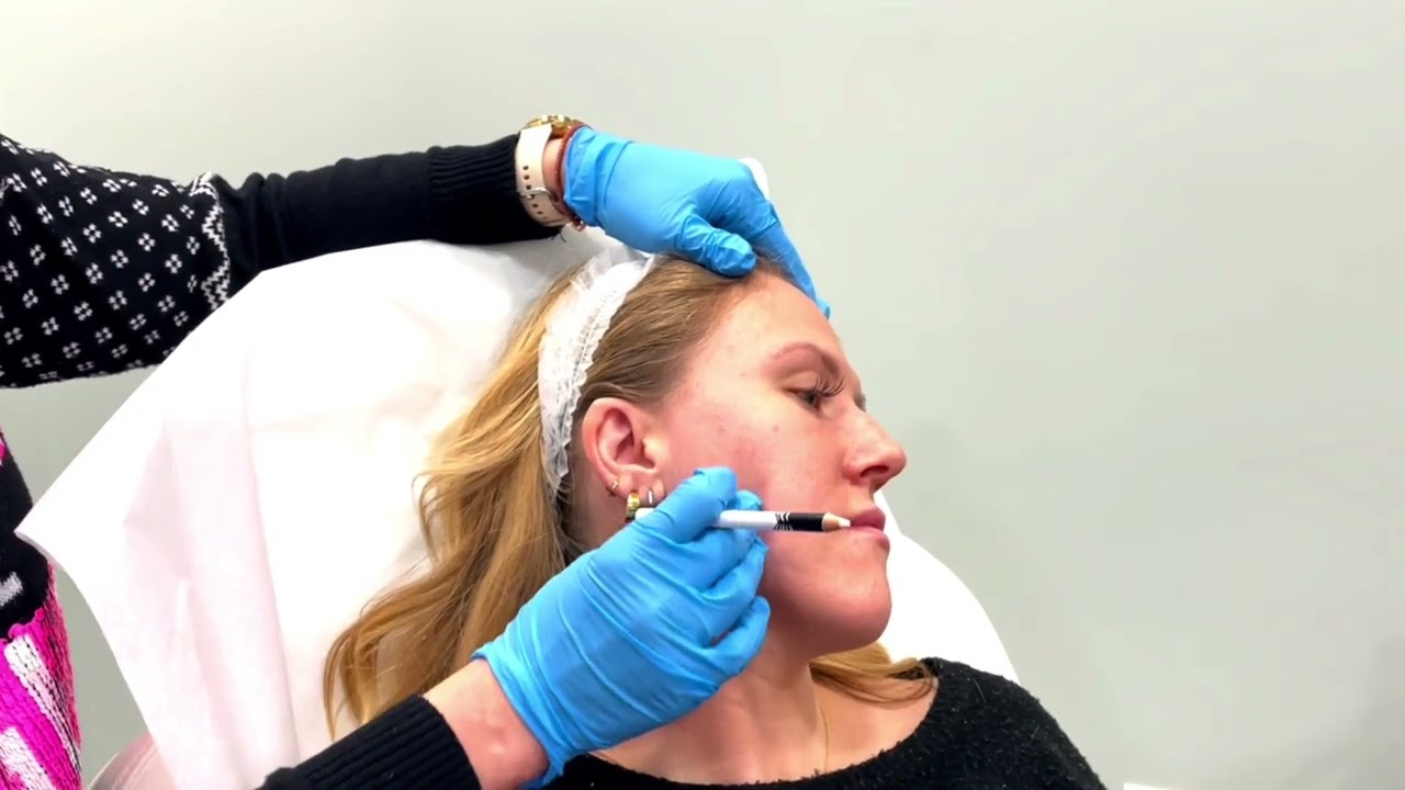 Volux Filler  for Jawline  - Full Treatment and Before and After Photos
