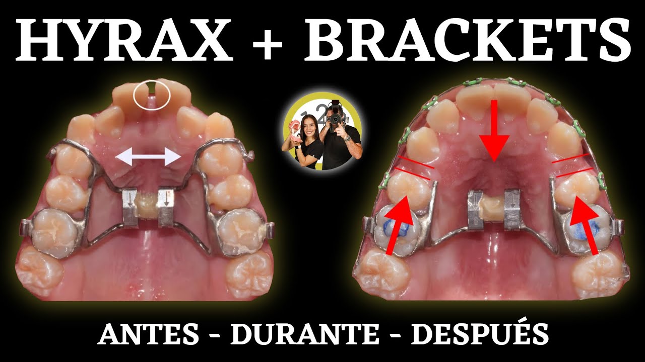 Proceso 𝗠𝗘𝗦 𝗮 𝗠𝗘𝗦 | HYRAX + BRACKETS | Tratamiento ORTODONCIA