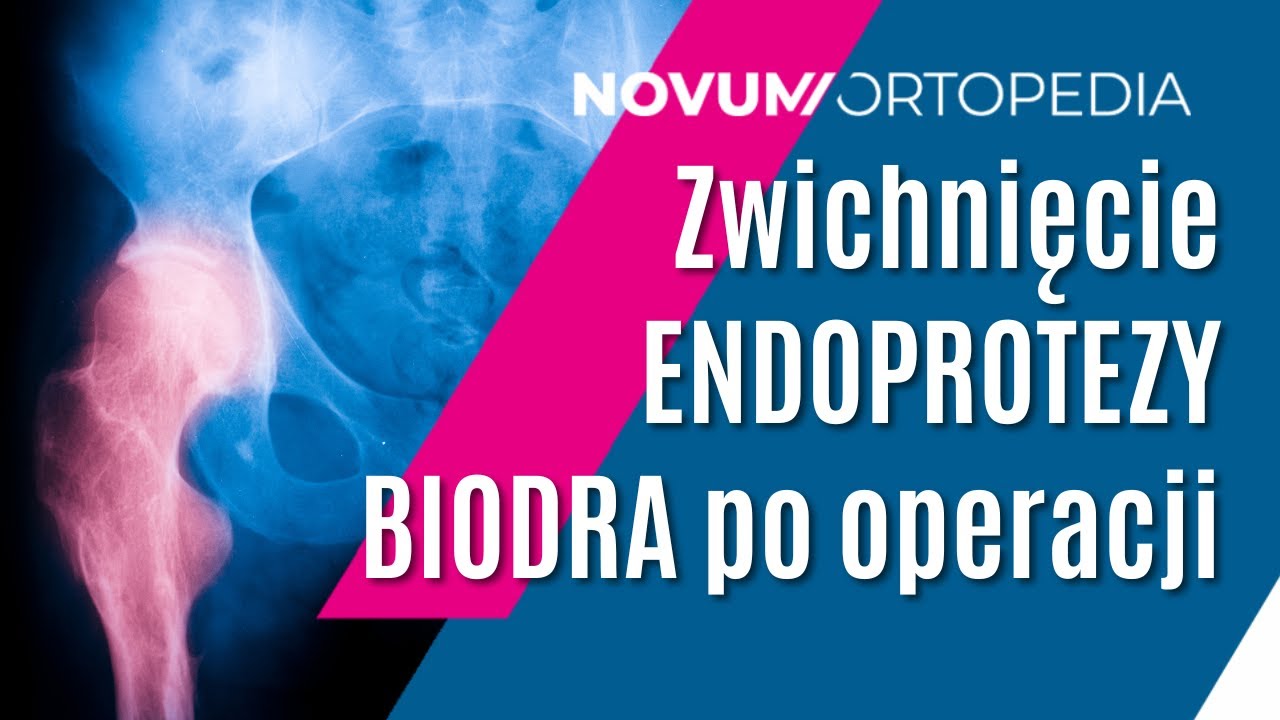 ZWICHNIĘCIE ENDOPROTEZY stawu BIODROWEGO: ryzyko i przyczyny | Novum Ortopedia