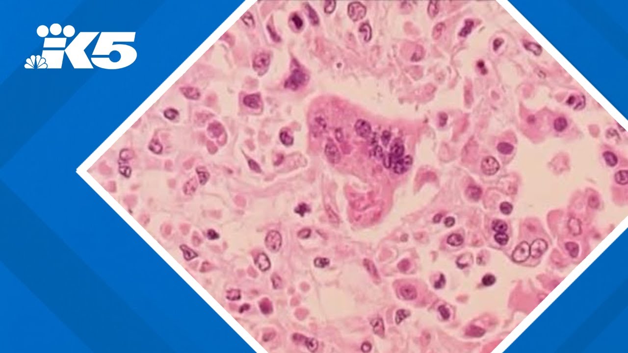 First case of measles in WA this year identified, officials warn of King County exposure locations