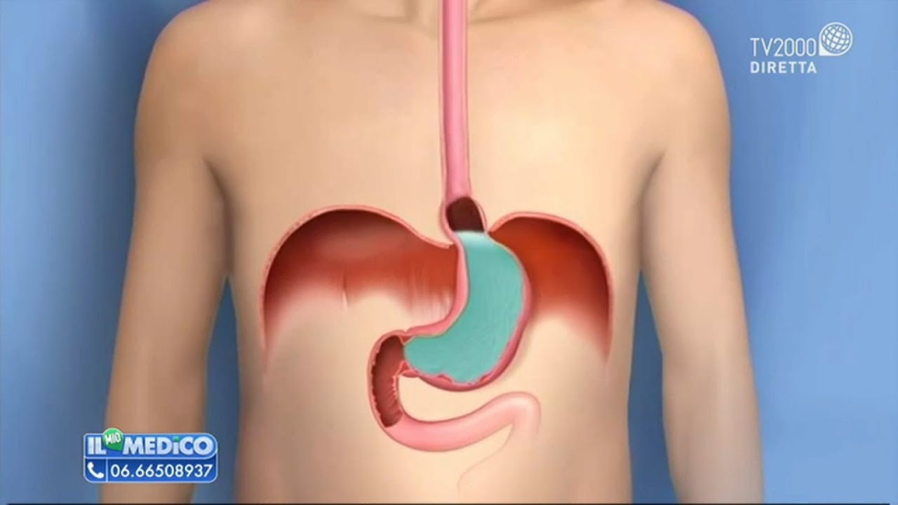 Il Mio Medico - Singhiozzo tutte le cause