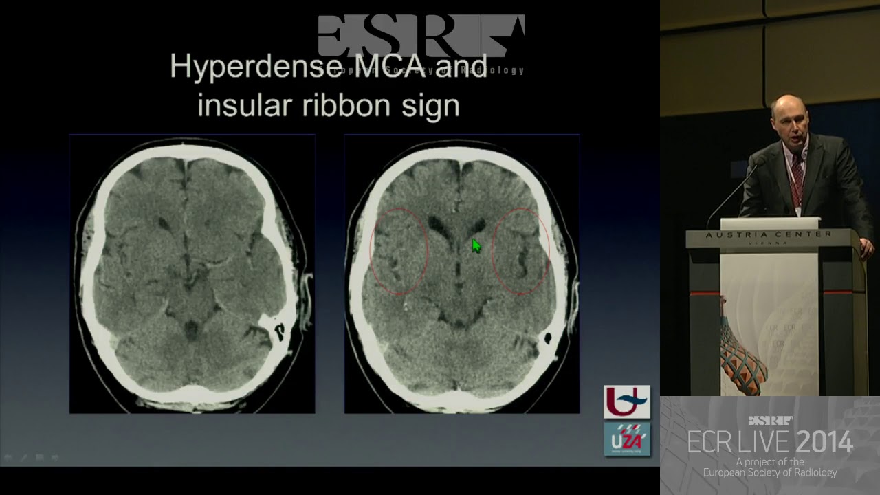 Neuro - Stroke diagnosis, mimics and treatment 1