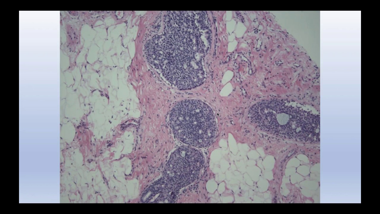 Breast Pathology 101 - November 2019 Webinar