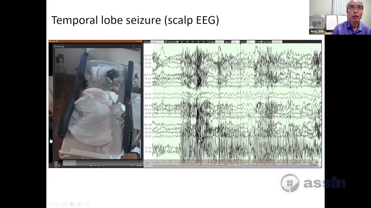 Epilepsy Surgery Part I, Surgical Decision Making | ASSFN Webinar