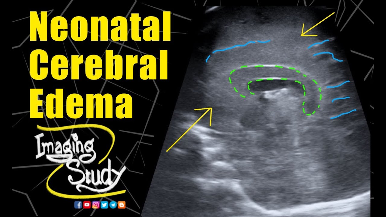 Neonatal Cerebral Edema || Ultrasound || Case 278