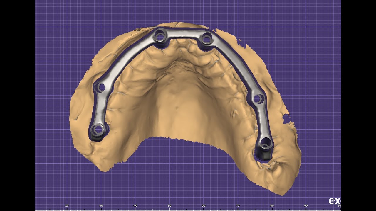How to Design for upper ALL ON 6 TITANIUM bar designing in Exocad Elefsina?