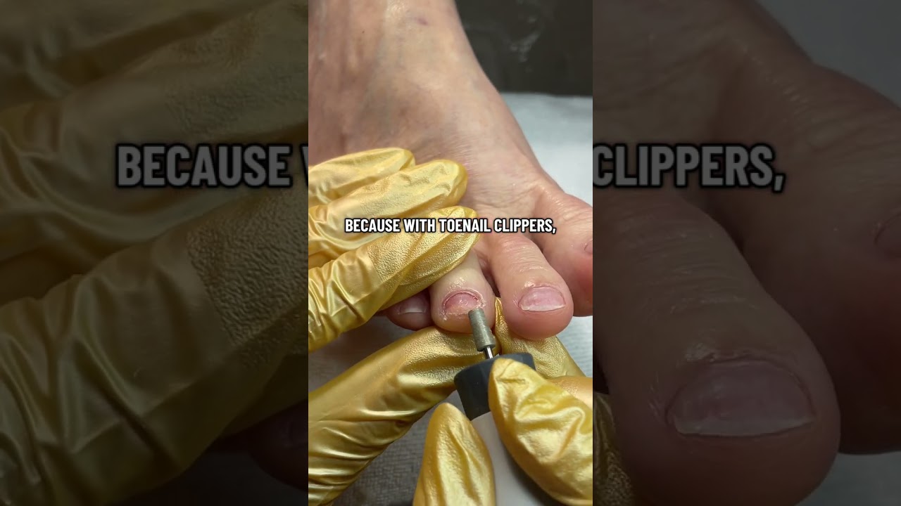 Damaged nail - deep cleaning - advanced Pedicuring at Elite Feet & Studio