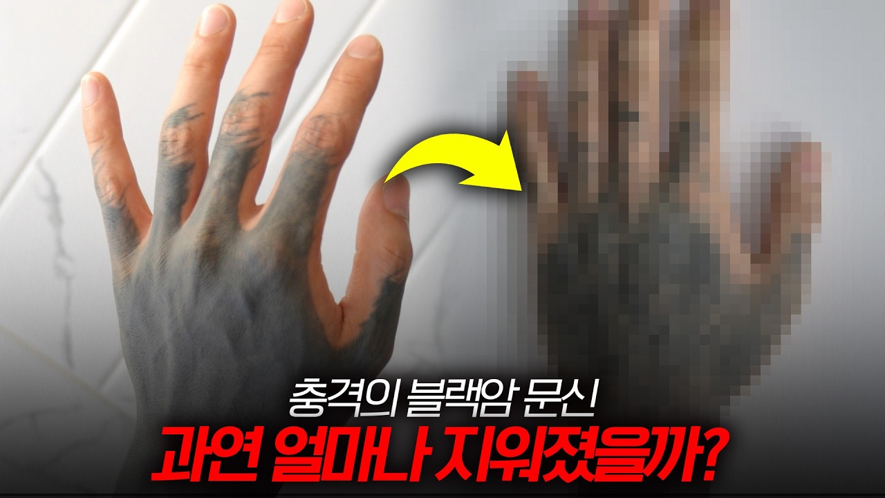 제가 지워드린 문신들 경과를 공개해드리겠습니다. (포토샵 전혀 안했어요)
