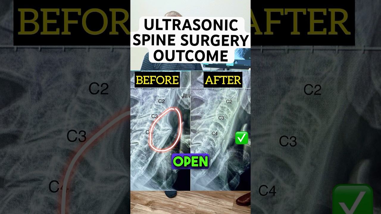Life-Saving 𝐔𝐥𝐭𝐫𝐚𝐬𝐨𝐧𝐢𝐜 Spine Surgery Technology🤩⚙️🔬