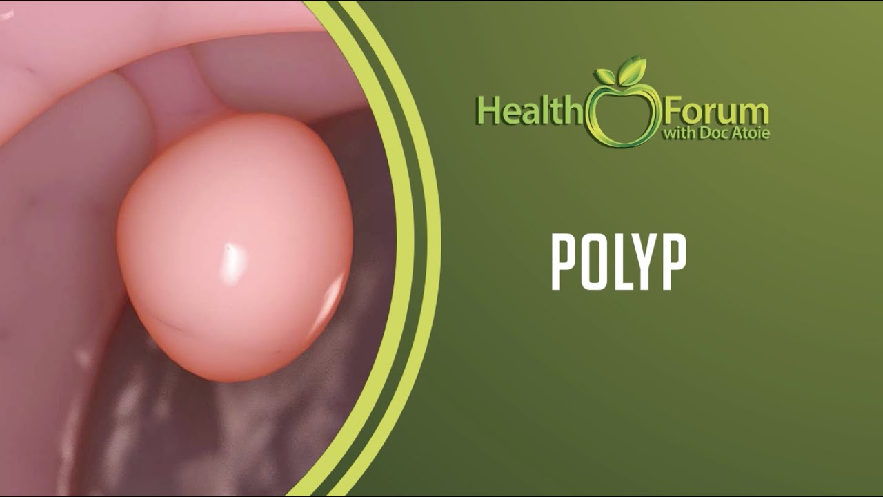 24 January 2020 | Word of the Day: Polyp