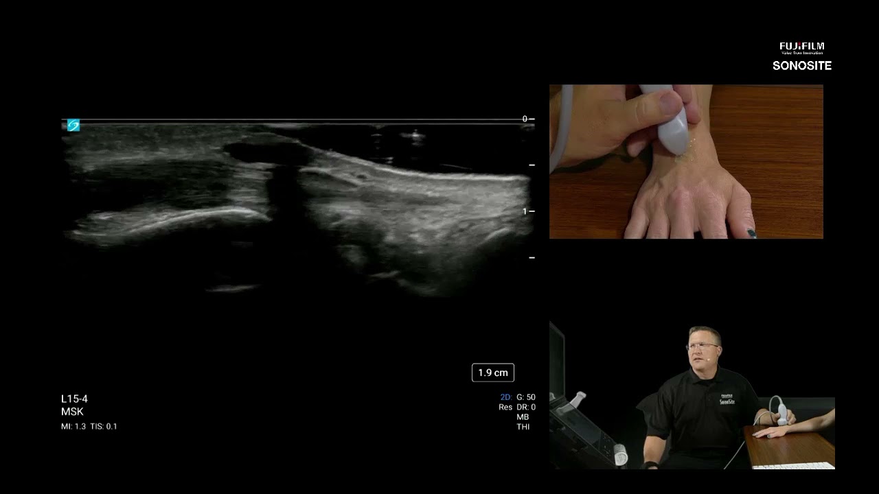 Webinar: Ultrasound Evaluation of the Dorsal Wrist