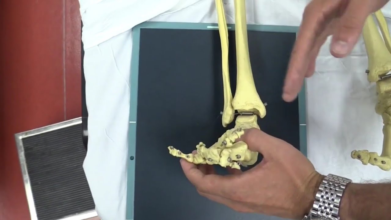 fratura do maléolo medial da tíbia, lesão da sindesmose, entorse de tornozelo