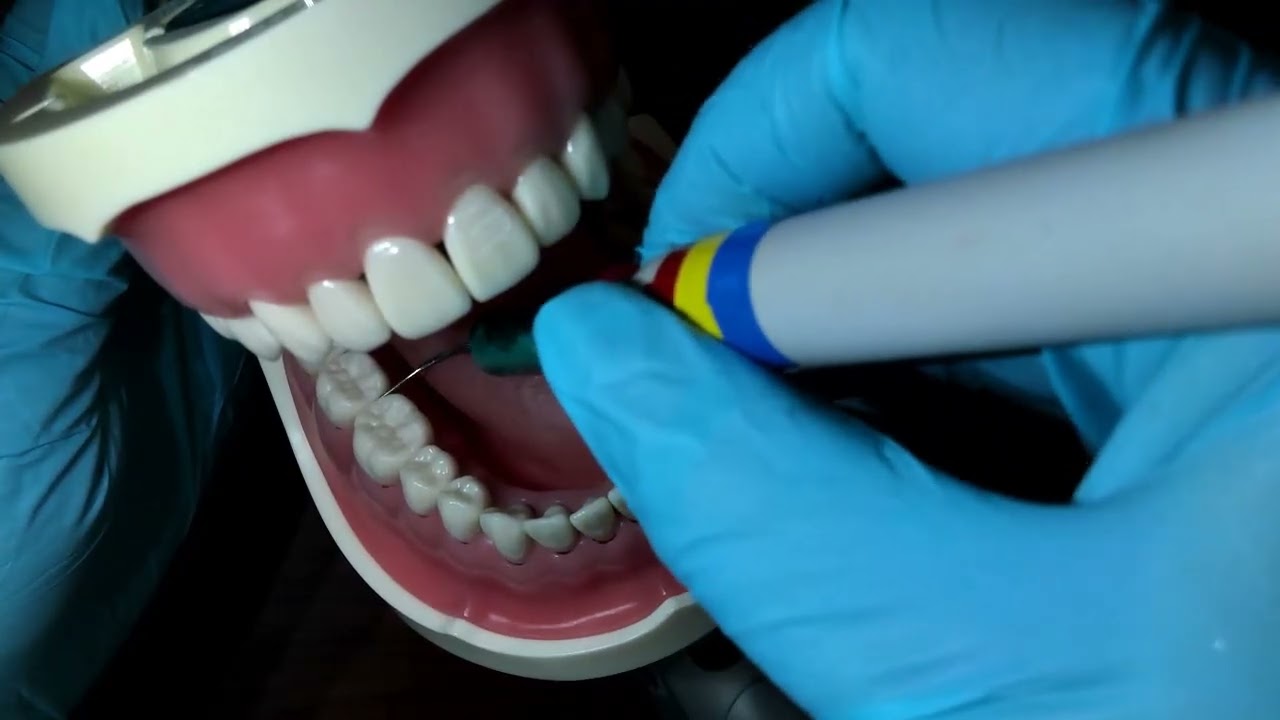 Ultrasonic scaler tooth #30 lingual