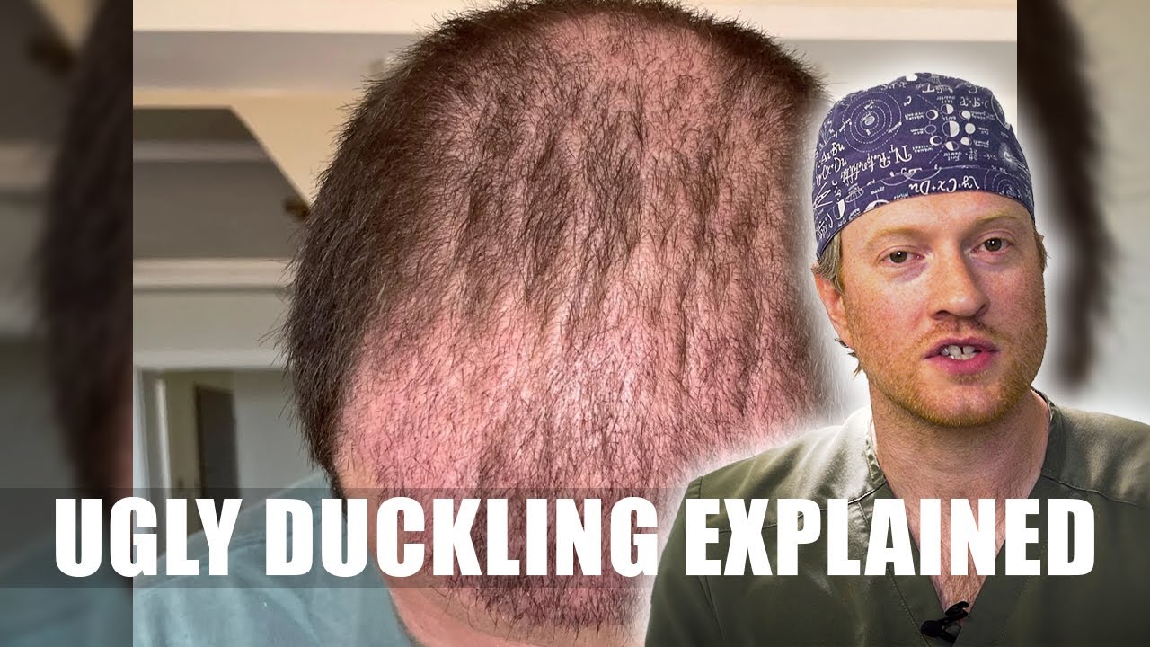 The Ugly Duckling Stage of a Hair Transplant (What to Expect & When It Ends)