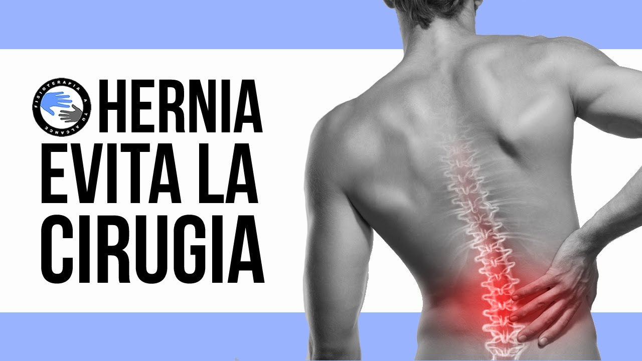 Hernia discal, 3 ejercicios para evitar la cirugia