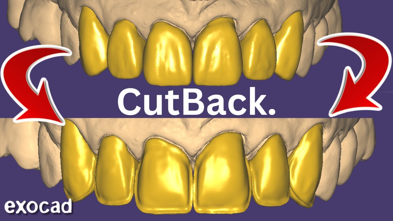 Большие корпуса CutBack EXOCAD. Для многослойной укладки.