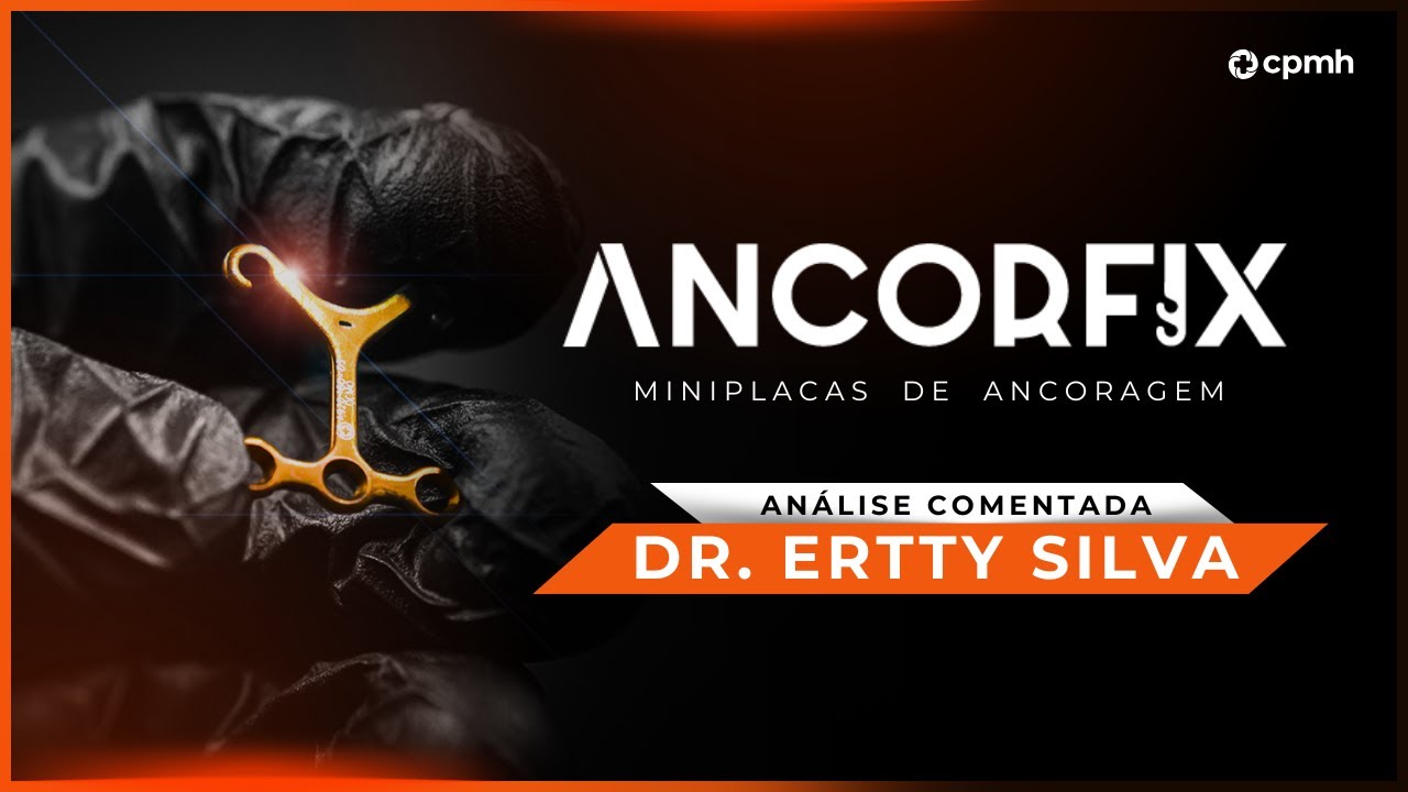 ANCORFIX | Dr. Ertty Silva comenta as novas miniplacas