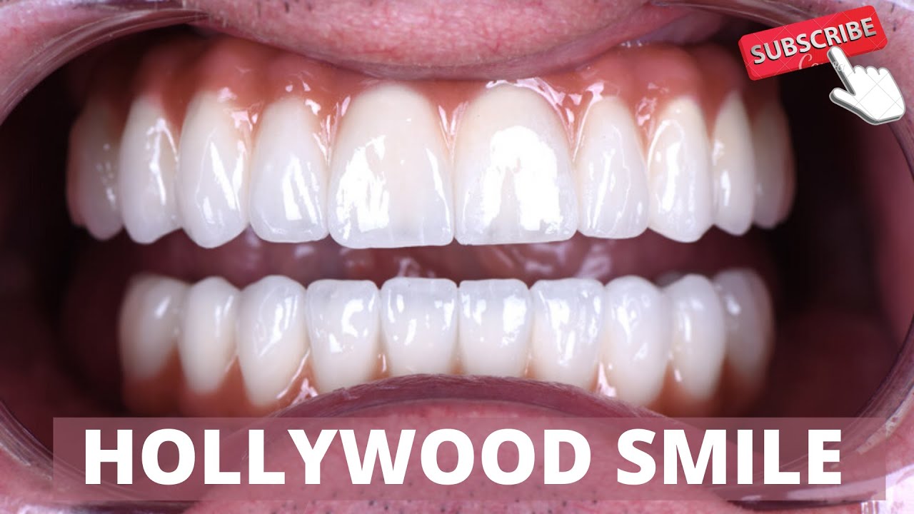 Šta je to Hollywood smile?