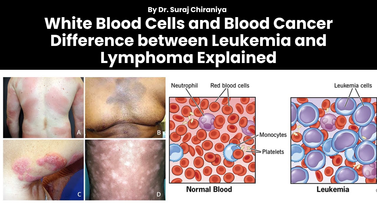 Белые кровяные клетки и рак крови | Объяснение разницы между лейкемией и лимфомой