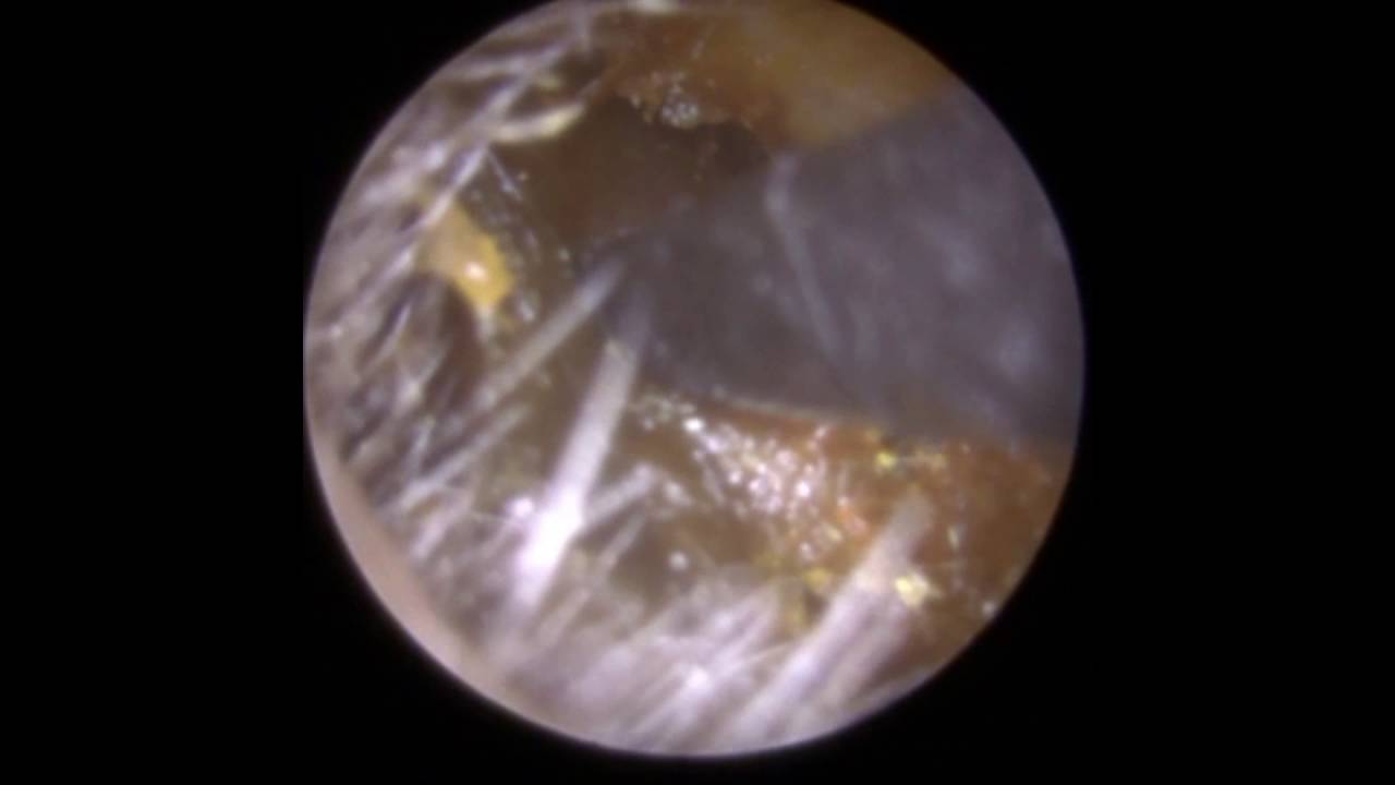Instant Ear Wax Removal Leicester - Mr Neel Raithatha (The Hear Clinic - Leicester)