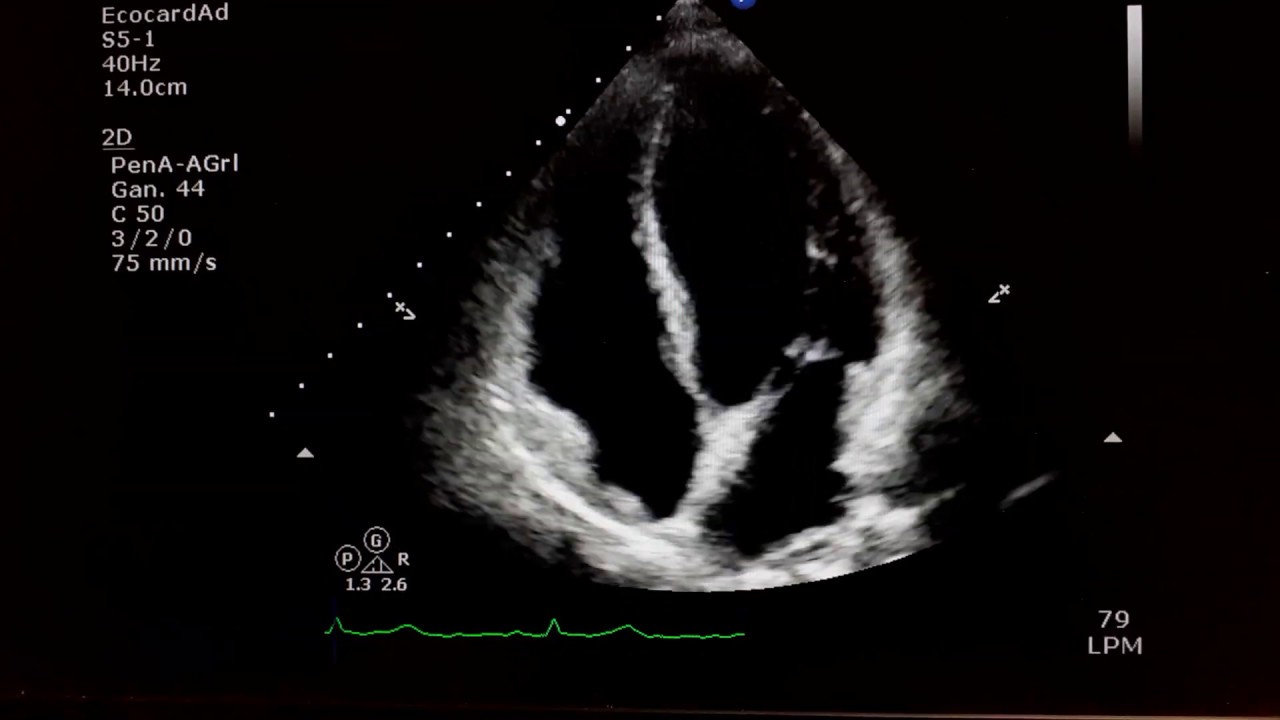 Ecocardiograma, fraccion de expulsion. FEVI. Cardiologia Vallarta.