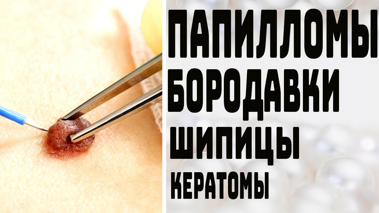 УДАЛЕНИЕ ПАПИЛЛОМ / БОРОДАВОК, ШИПИЦ / КЕРАТОМ  ВИРУС ПАПИЛЛОМЫ ЧЕЛОВЕКА  ПРИВИВКА ОТ ПАПИЛЛОМЫ