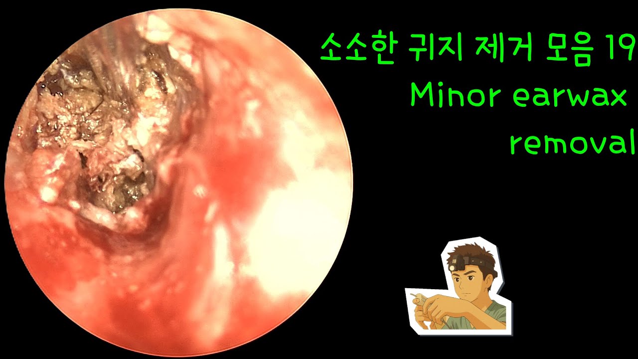 소소한 귀지 제거 모음 19 (Minor earwax removal)
