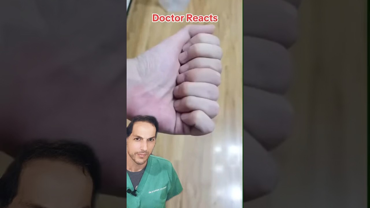 Polydactyly (extra fingers) occurs in 1/750 live births #extra #finger #polydactyl #medicalstudent