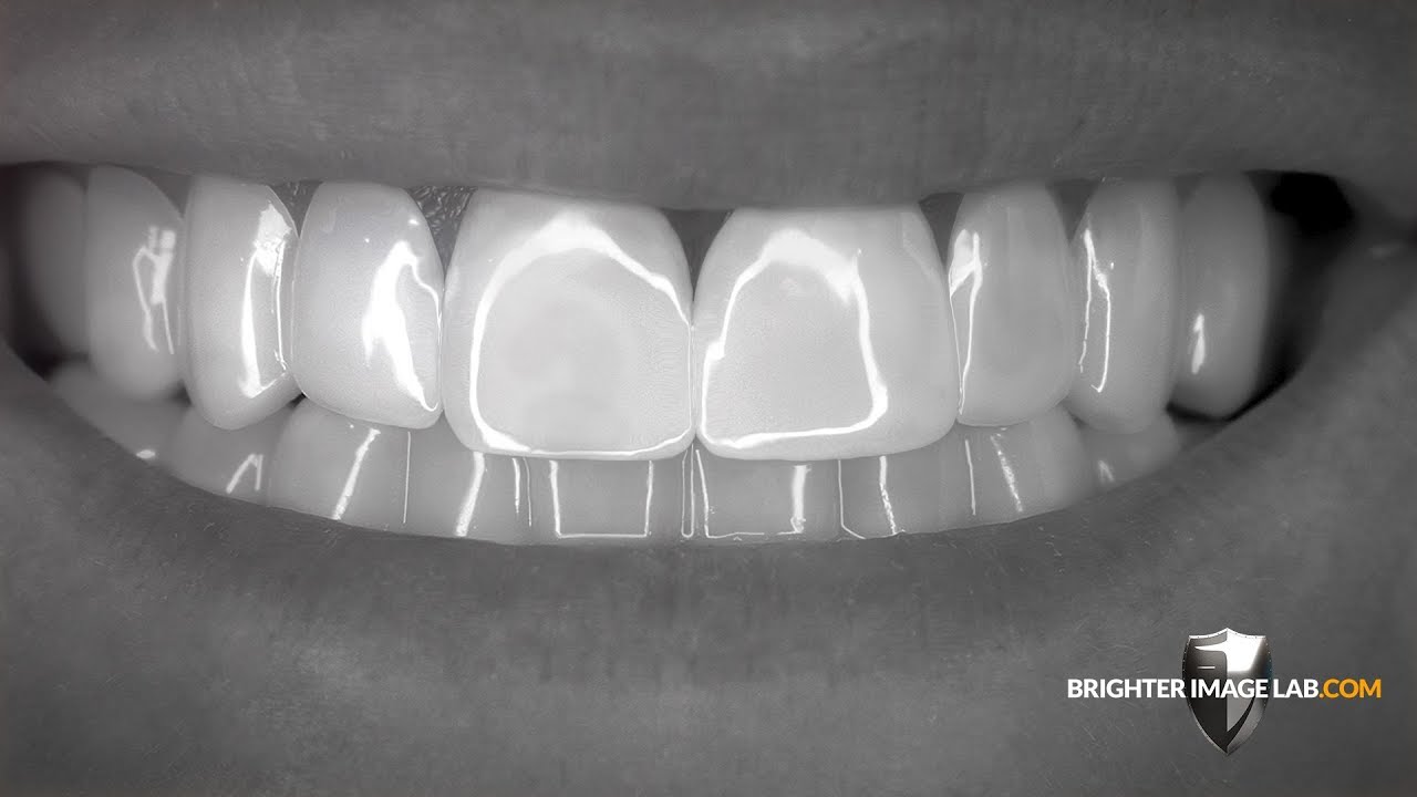 Brighter Image Lab BilVeneers&trade; The Future of No Dentist Dental Veneers!