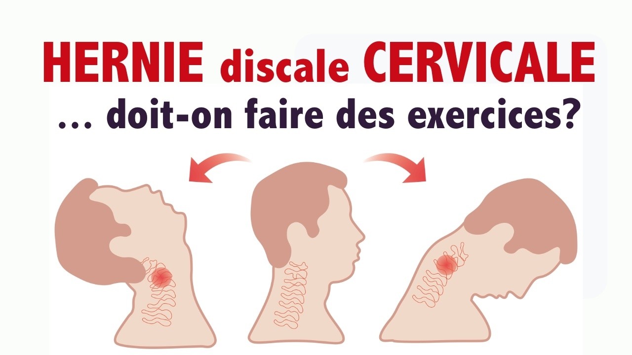 HERNIE DISCALE cervicale:  faire ou ne pas faire d'exercices?