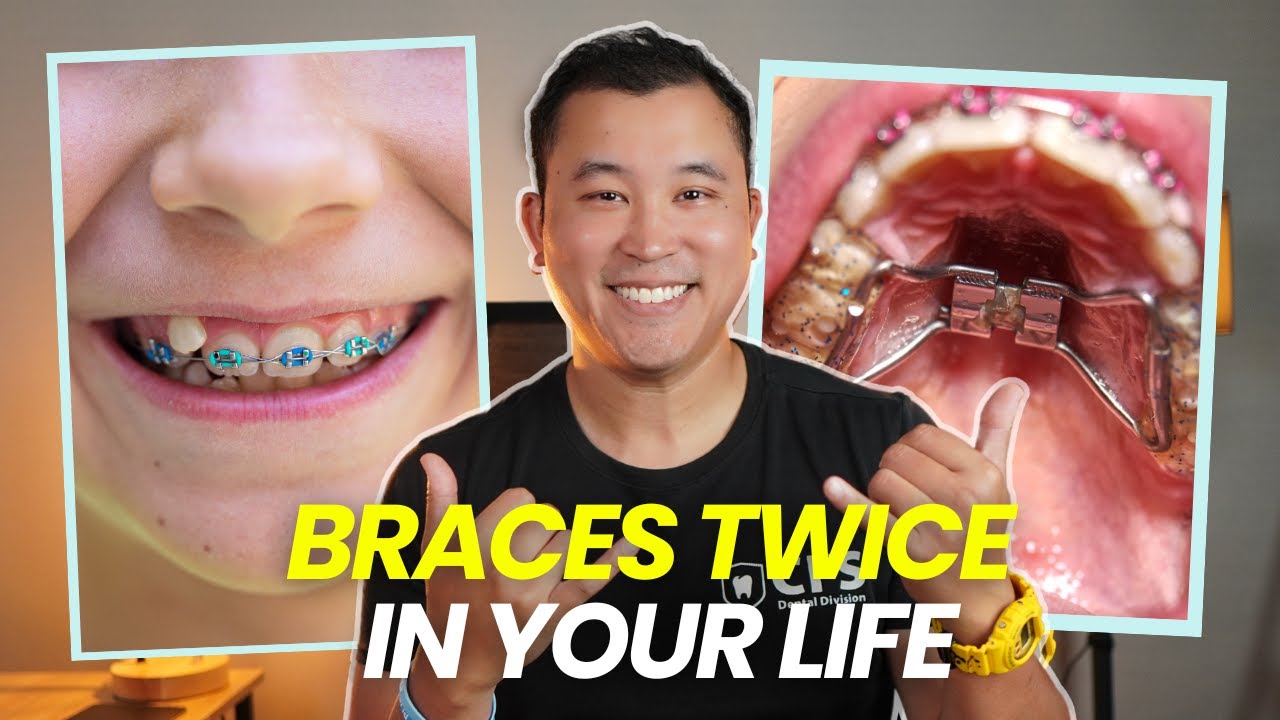 Do You Actually Need Early Braces? Early Interceptive Orthodontic Phase I Treatment Explained