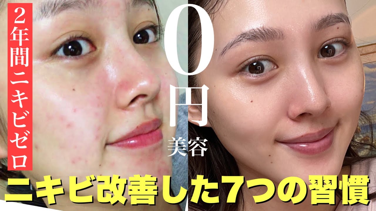 【激変】ニキビを治す方法。長年悩んでいた肌荒れ地獄から脱却した7つの習慣【乾燥肌敏感肌】