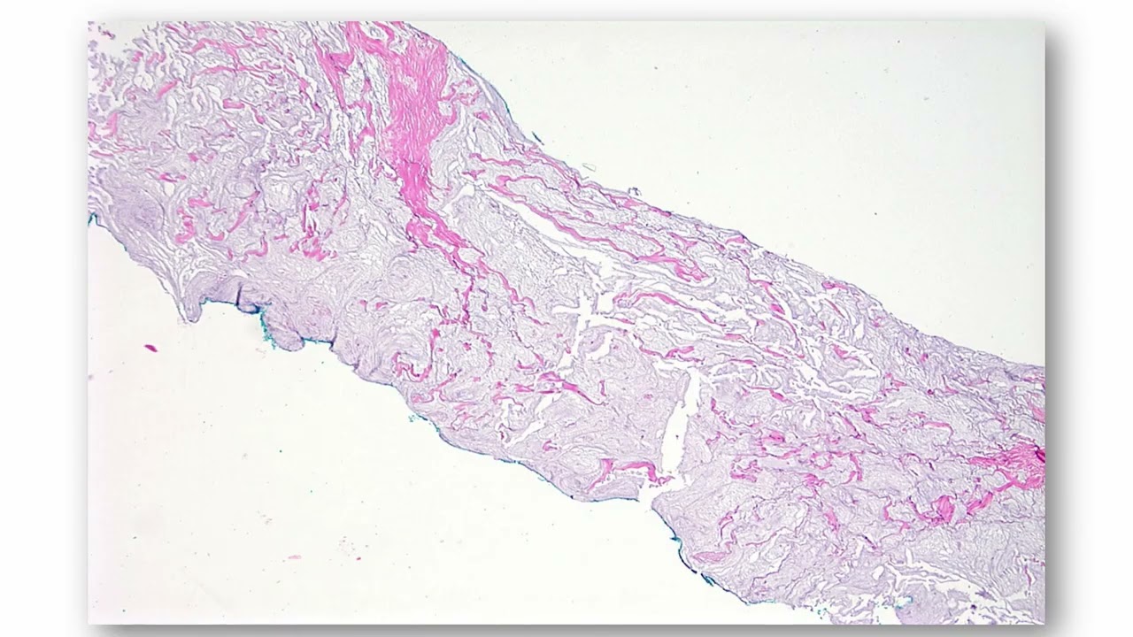 AP-IAP 2025, Breast Pathology,  Laura Collins